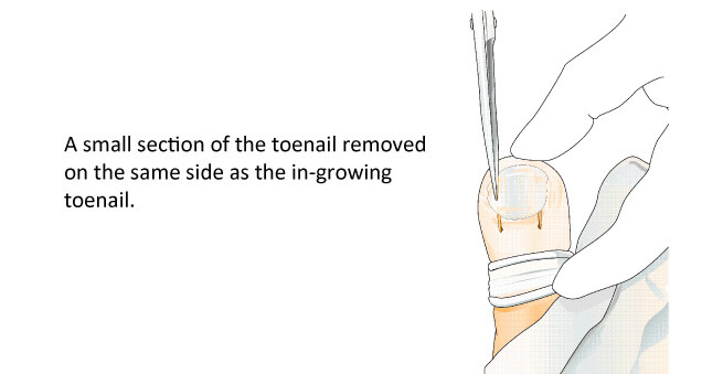 In growing toenails
