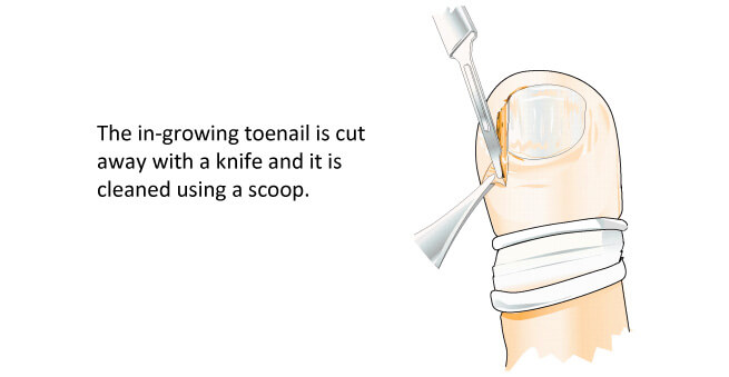 In growing toenails