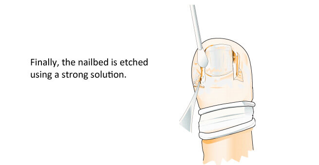 In growing toenails